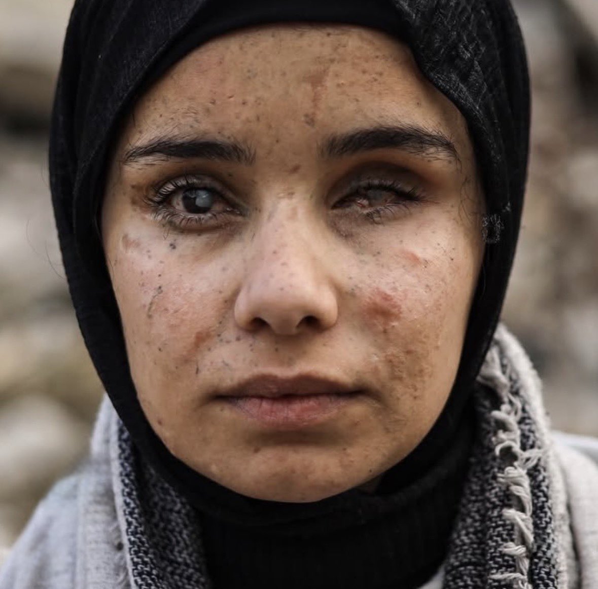Israel did this to this little girl from Gaza.
Never forget.