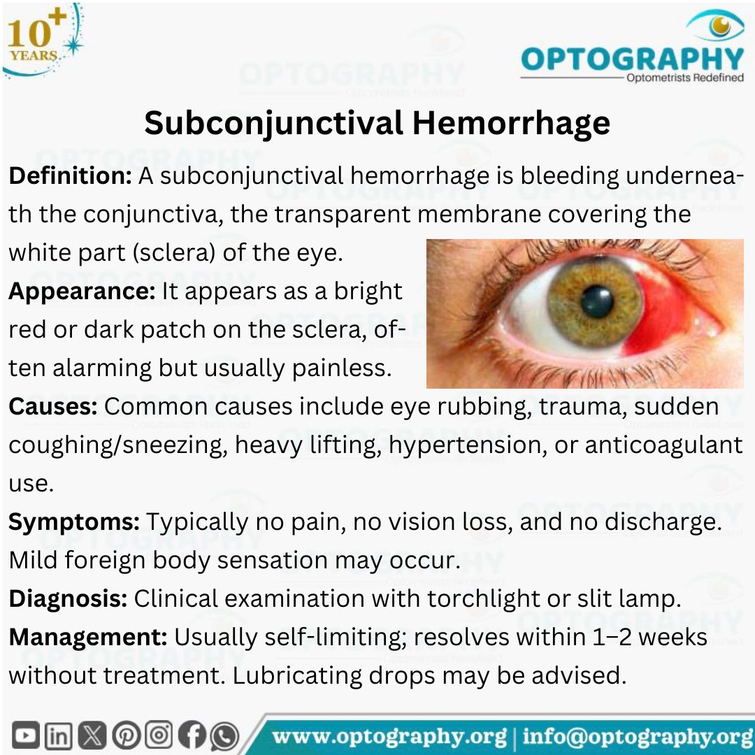 Optography8's tweet image. A red patch on the eye can look scary, but most subconjunctival hemorrhages are harmless and self-resolving 👁️
#SubconjunctivalHemorrhage #EyeHealth #OptometryLife #KnowYourEyes #Optography #PrimaryEyeCare #Optometrist #Thatoptometrist