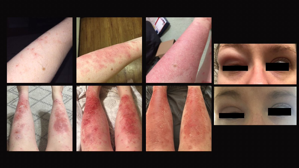 MelodicMind09's tweet photo. Hey Mark, I’ve been stuck in the appeal process because of a patent lift and @AnthemBlueCross formulary change. Humira isn’t covered now but I have a severe allergy to many biologics. Doctor doesn’t want me to switch. I’ve been without meds for 3 months. This is what life looks like when I miss doses 👇🏻

Please help us! It’s a fight every year.