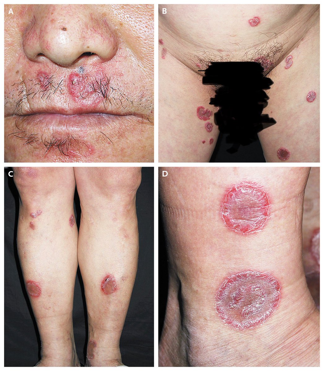acm2009's tweet photo. @cecilezechman @TMZ @KingOfCampSZA Nope that’s #syphilis https://t.co/rwxMoVTSfo