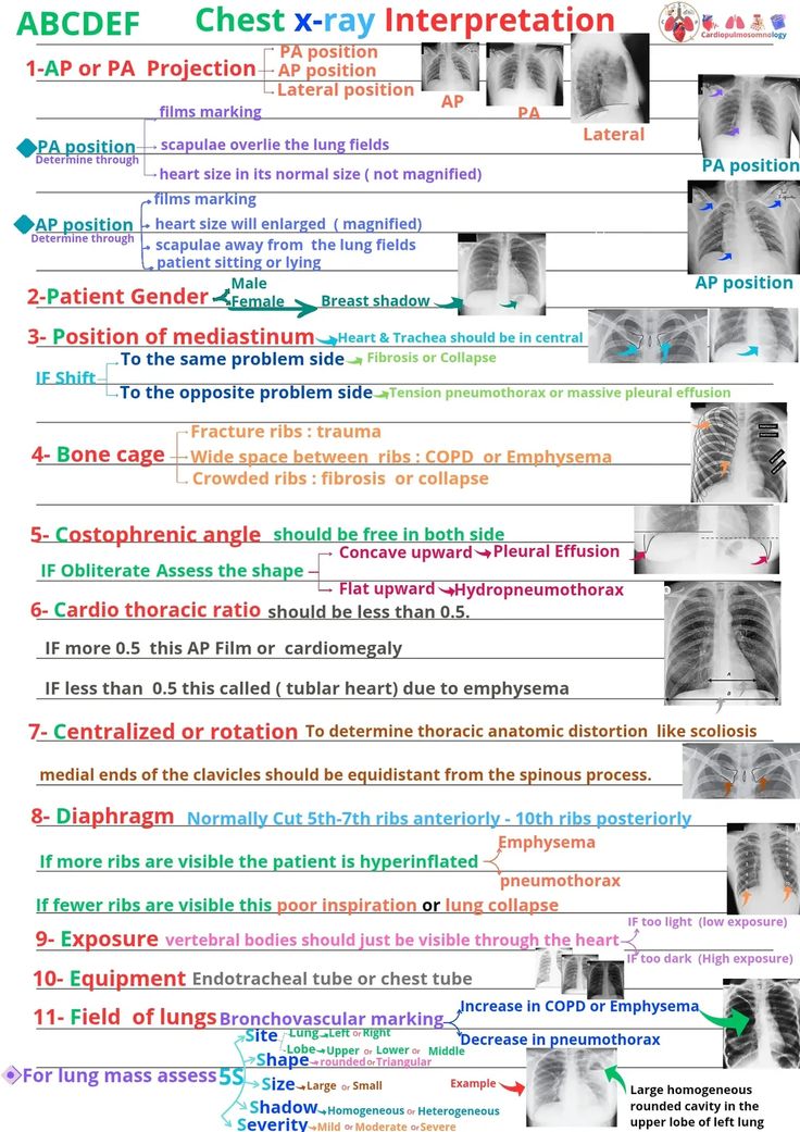 TrackYourHeart's tweet photo. If you follow ABCDEF, chest X-rays stop being intimidating. https://t.co/8CzhG1wyI7