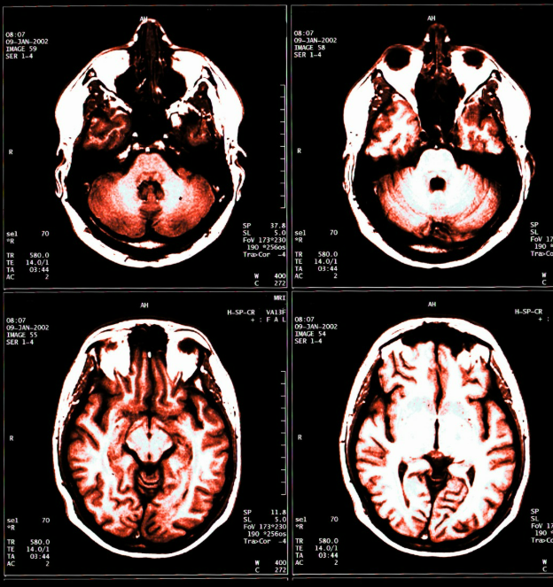 INNMEDSCAN's tweet photo. 🧠 Imagine if MRI could merge with PET… That’s the future we aim to build: a hybrid PET-MRI scanner that combines precision with sensitivity for earlier and more complete diagnoses. 🚀 https://t.co/VzvHtccbsi