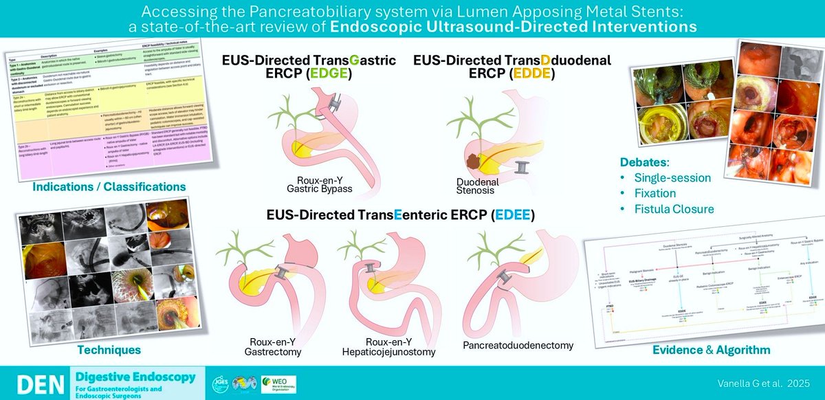 GVanell5's tweet photo. 🔓 #LAMS to regain access to the #pancreatobiliary system in #SurgicallyAlteredAnatomy?
👉 #EUS-directed interventions (#EDGE, #EDEE)
#indications, #techniques, open #debates, and anatomy-based clinical #algorithm.
Thank you @jges1959 for inviting us.
https://t.co/9cneBMa0er https://t.co/G8FqDOjEPs