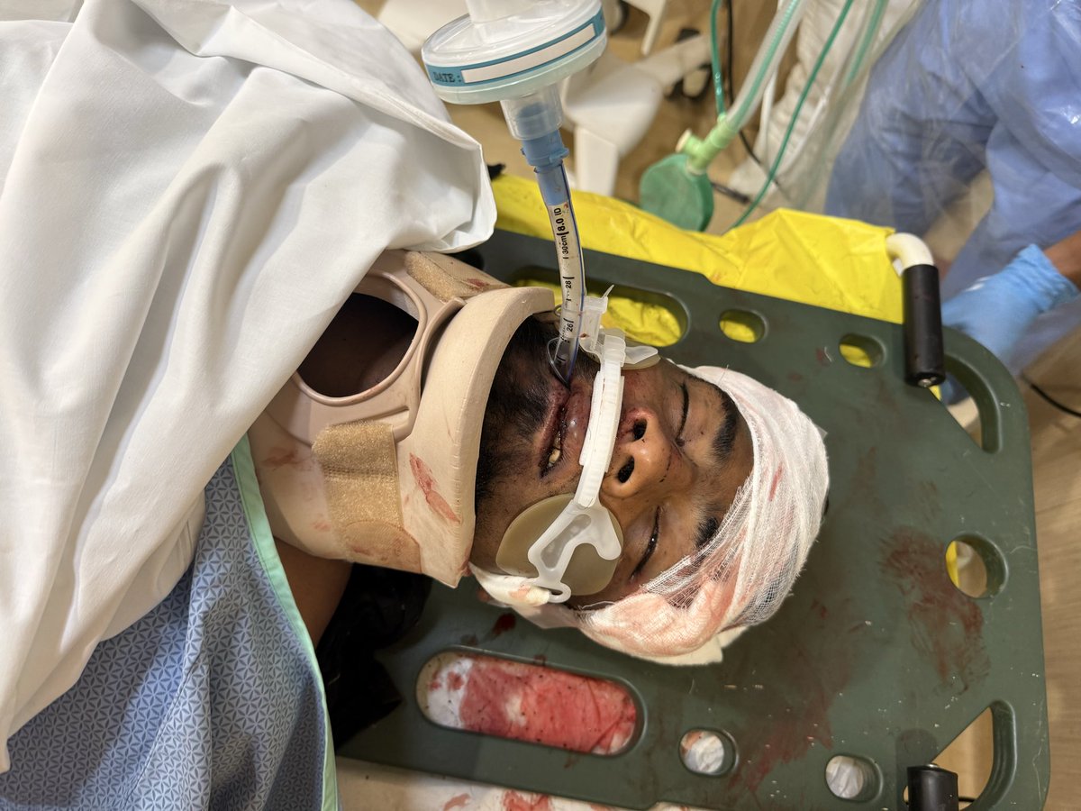 pdn_Dr's tweet photo. @naralokesh &amp; @PawanKalyan @AndhraPradeshCM My brother Tummala Pradeep TDP active member from madanapalle. My brother was assaulted to murder by group of people who are #YCPfollowers on 25/03/2026 around 9.45 pm &amp; has been admitted in Manipal Hospital for Traumatic Brain injury. https://t.co/7QRBgP4Q9k
