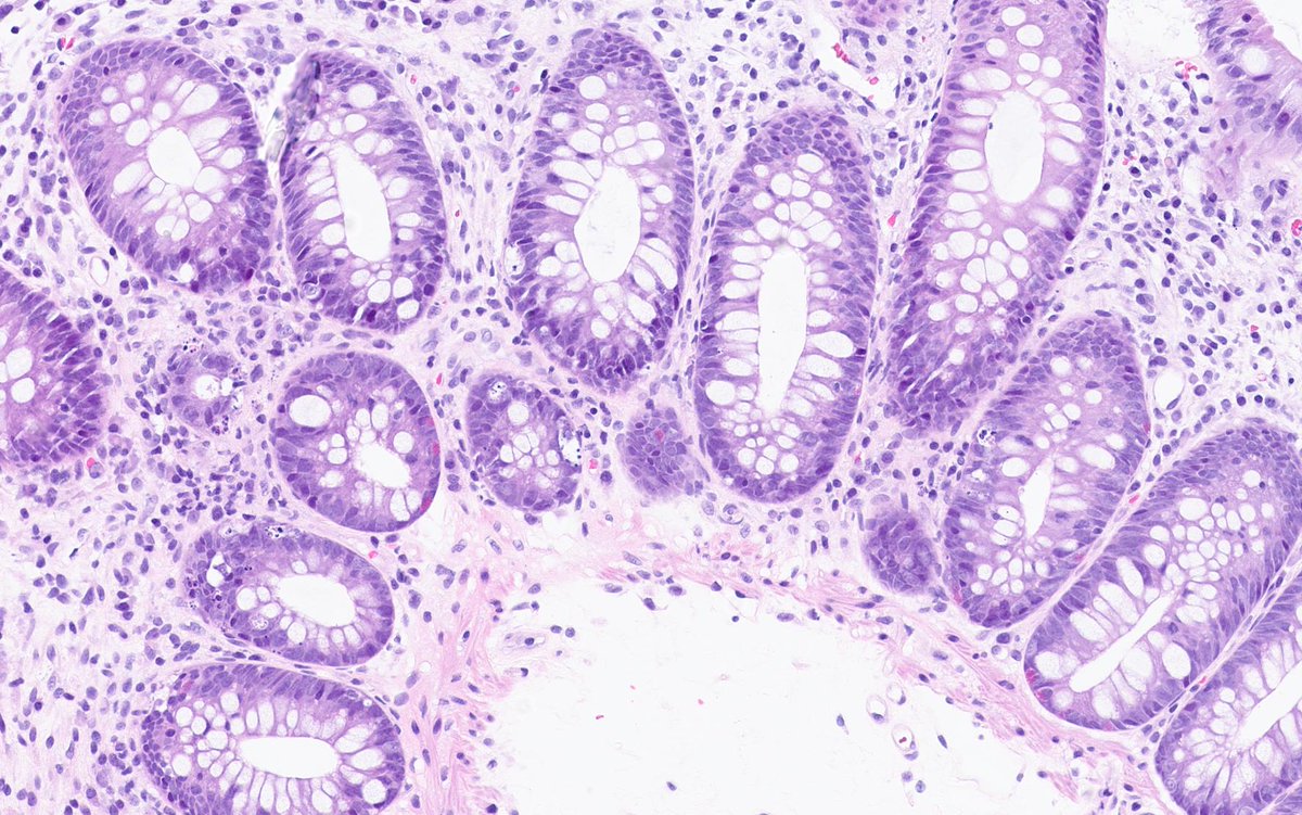 🔬 Intestinal graft-versus-host disease can show numerous apoptotic bodies within colonic crypts, an important clue after allogeneic stem cell transplantation for Myelodysplastic syndrome.

Dr Johanna Köhler, Pathologist &amp; ESP Alumni, Sweden
#EveryDayPathology #PathX