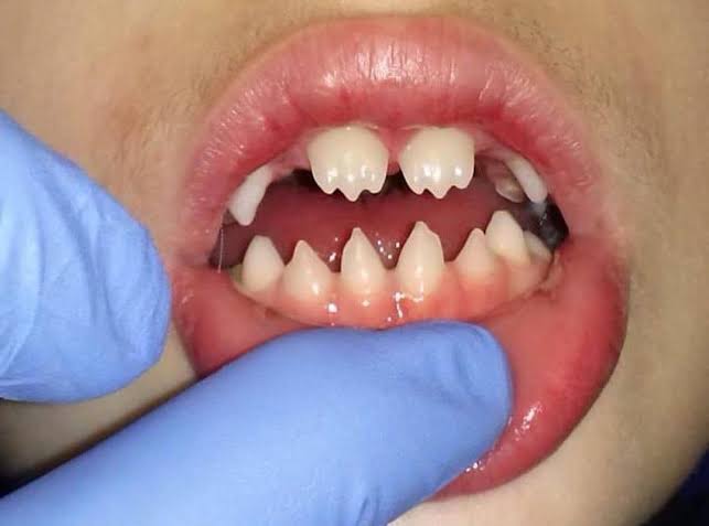 DocPriyamMD's tweet photo. A 7-year-old is brought to your clinic for a routine check-up. The parents are mostly worried about his grades and some slight hearing difficulty they've noticed lately.

But when he smiles, you see this.

What is the diagnosis, and what other sign are you hunting for in your physical examination?