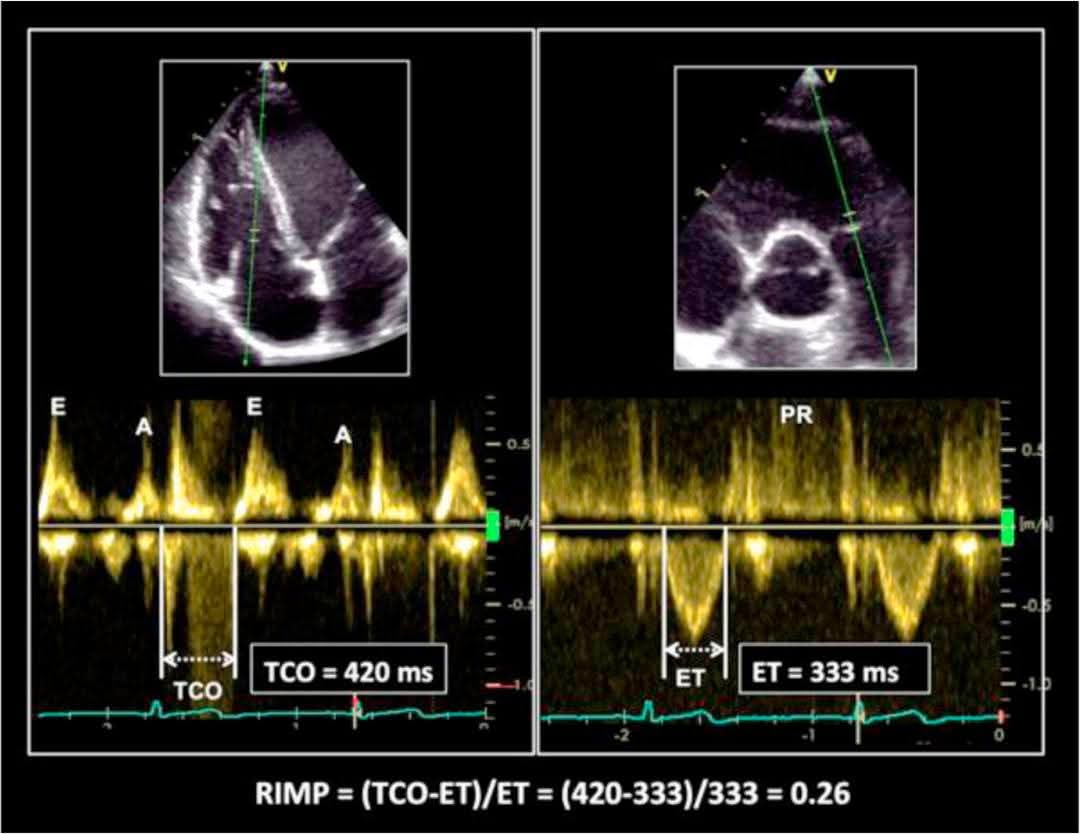 Ahmedata7777's tweet photo. 🫀 RV TEI Index (Myocardial Performance Index)

The TEI index is a Doppler-derived parameter that assesses global right ventricular (RV) function — combining systolic + diastolic performance in one number.

》Formula

TEI Index = (IVCT + IVRT) / ET
OR 
TEI Index = (TCO - ET) / ET

📊 Normal Value (Right Ventricle)

Normal RV TEI index:
< 0.40 (Pulsed Doppler)
< 0.55 (TDI method)

Higher value = worse global RV function

📍 How to Measure

1️⃣ Pulsed Doppler
Uses tricuspid inflow + pulmonary outflow
Measured from 2 beats
Normal < 0.40
More load & HR dependent

2️⃣ Tissue Doppler (TDI)
Sample at lateral tricuspid annulus
Measured from 1 beat
Normal < 0.55
More accurate & reproducible

📈 What Does It Mean?
🔹 Increased TEI index indicates:
RV systolic dysfunction
RV diastolic dysfunction
Pulmonary hypertension
RV infarction
Congenital heart disease
Seen commonly in:
Pulmonary hypertension
Right ventricular infarction

🧠 Exam Pearl
High TEI = more isovolumic time, less ejection time → worse global RV function.