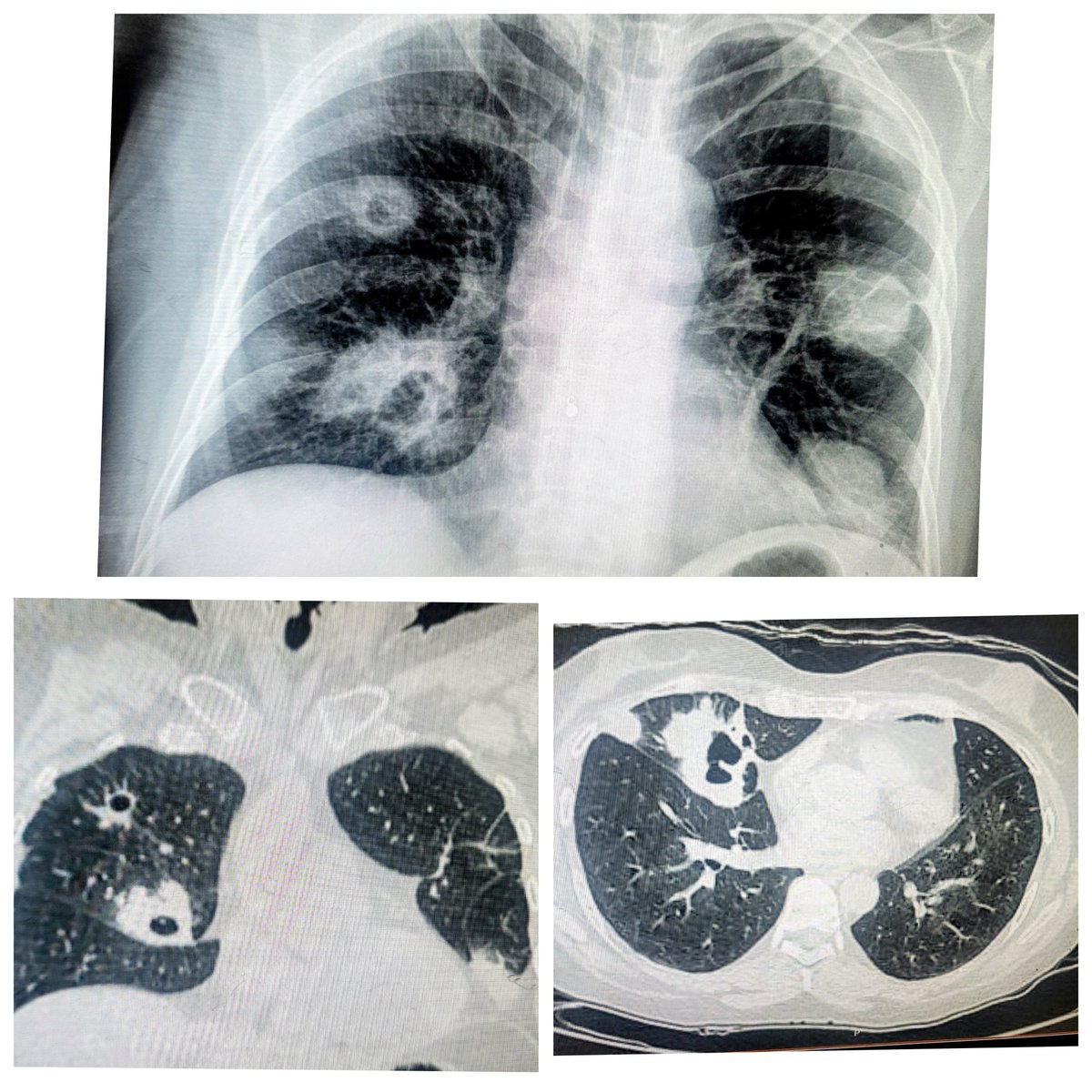 ConsejosReumato's tweet photo. Nódulos pulmonares (cavitados) en mujer de  54 años con granulomatosis y poliangiitis (#wegener), presentó ANCA positivo , además nariz "silla de montar" (#saddlenose), #sinusitis, #hipoacusia y neurooatía periférica. Mejoró con #corticoides y #ciclofosfamida . #vasculitis ##ANCA https://t.co/6zT06bj0Mt