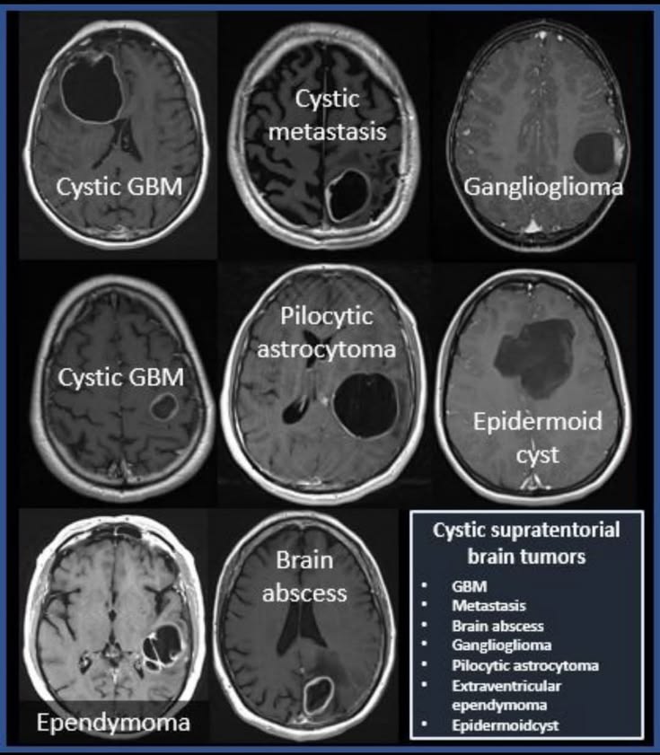A comparative overview of common cystic supratentorial brain tumors.

<a href="/theneuroradguy/">The Neuroradiologist</a>