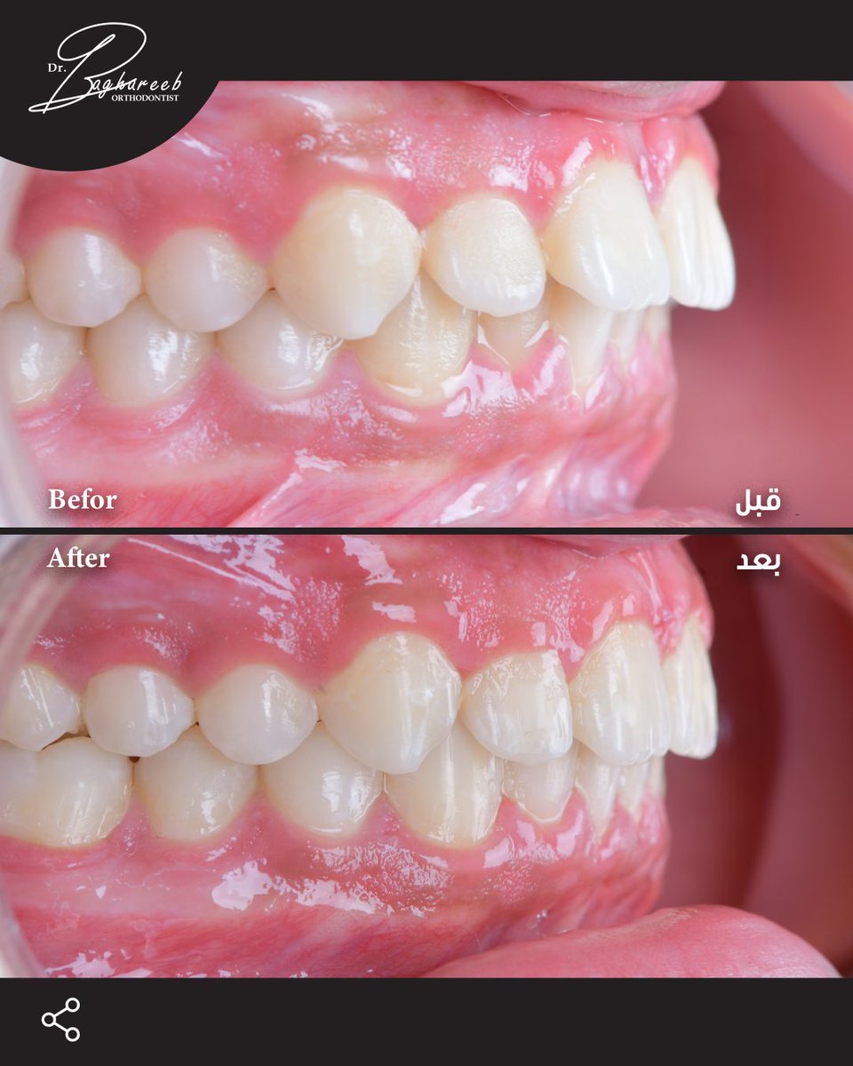 dr_baghareeb's tweet photo. في هذه الحالة ركّزنا على:
• إغلاق المسافات بين الأسنان العلوية
• تصحيح الفلجة وتحسين اصطفاف الابتسامة
• فكّ التزاحم في الأسنان السفلية وتنظيمها
• الحفاظ على الإطباق الطبيعي بدون التأثير على علاقة الفكين

تم علاج الحالة خلال ٤ أشهر فقط بالتقويم الشفاف الانفزلاين 👏🏻 https://t.co/7A42FeVVa7