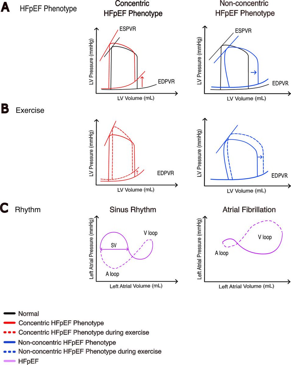Heart_BMJ's tweet photo. Atrial fibrillation and heart failure with preserved ejection fraction: diagnostic challenges and therapeutic opportunities https://t.co/QZR99Huymm https://t.co/kYovNWkbWu