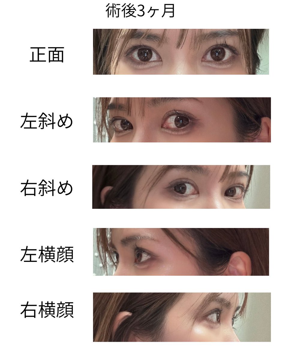 1118_3's tweet photo. 目の整形して半年が経ちました！
泣いた次の日でも目が腫れずそのままキープされ、糸も取れる事なく最高です😊🍊

自然癒着＋目つき矯正＋目頭切開
ウィ・ソンジェ先生 https://t.co/Ls0AAa61s8