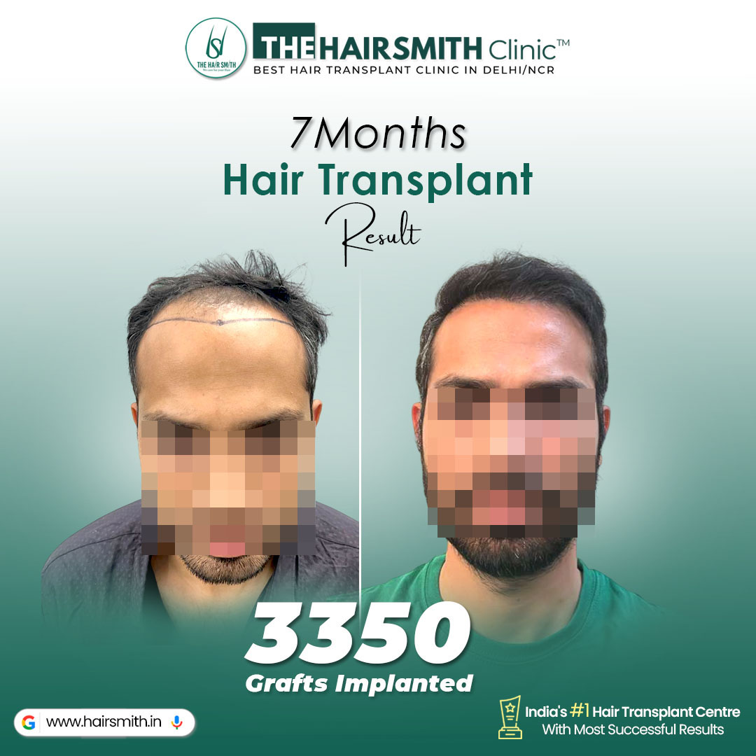 TheHairsmith's tweet photo. 7 Months. Real Growth. Real Confidence.  
Witness this stunning Hair Transplant Before &amp; After Result achieved with advanced UR-FUE Hair Transplant Technique at The Hairsmith Clinic – India’s #1 Hair Transplant Centre with most successful results.
WhatsApp: +91 9999481878 / 98 https://t.co/hyWxHSjVMM