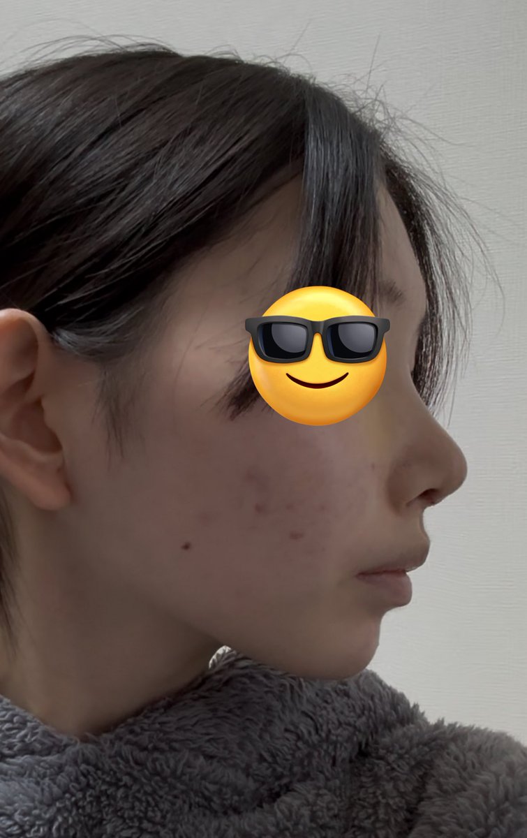 apmtgjptmtj's tweet photo. ビギンさんで鼻フルを行ってから1週間経ち本日抜糸してきました！
横顔がすごく綺麗！ナチュラルに鼻が高くなってて感動しました！😭
ビフォアフ載せてます！
まだ腫れている感じがありますが経過が楽しみです！！✨️
 #ビギン美容外科 #鼻整形  #鼻フル https://t.co/Rz6OtAIaN8