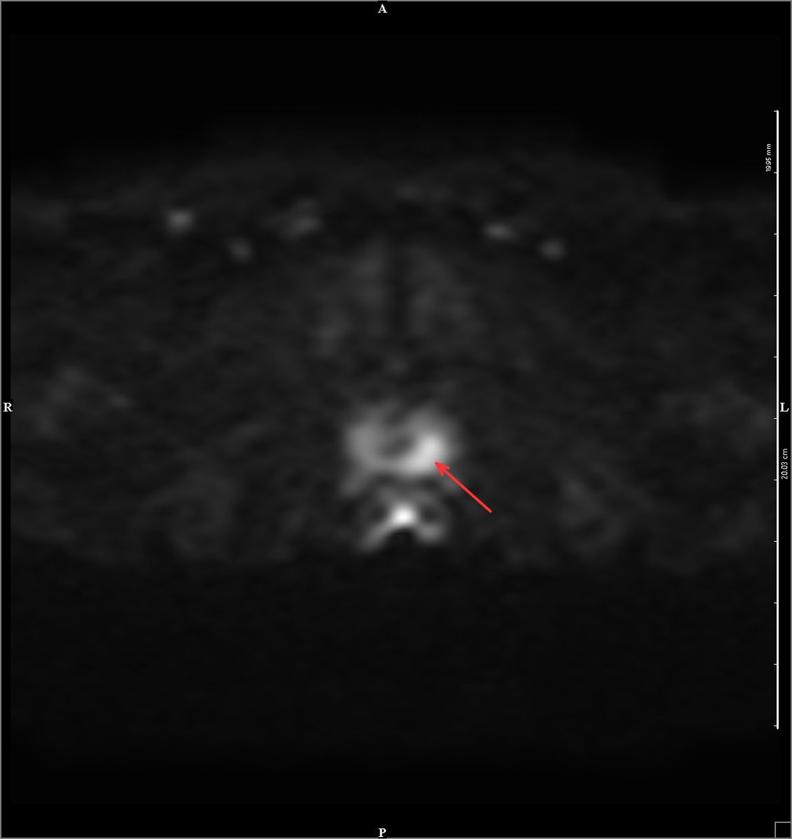 CoreViva's tweet photo. Case Insight: When PSA Isn’t Enough

A man in his 60s recently presented to CoreViva for a preventive whole-body MRI scan. He had a recent PSA s within the normal range (<4 ng/mL), and he had no known prostate concerns.

However, MRI revealed a suspicious lesion in the left peripheral zone of the prostate.

The patient underwent a targeted biopsy, which confirmed prostate cancer.

What are the takeaways from this case? 
• PSA screening can produce false negatives, leading to false reassurance
• MRI significantly improves detection of clinically significant prostate cancer
• Imaging guides more accurate targeted biopsies while reducing unnecessary procedures

As preventive imaging becomes more integrated into clinical workflows, cases like this reinforce the value of combining biomarkers with advanced imaging rather than relying on just blood tests.

Early detection changes outcomes.

What is your experience with patients who have prostate cancer with normal PSA levels? 
#health #wellness #cancerdetection #mri #medicalimaging #radiology