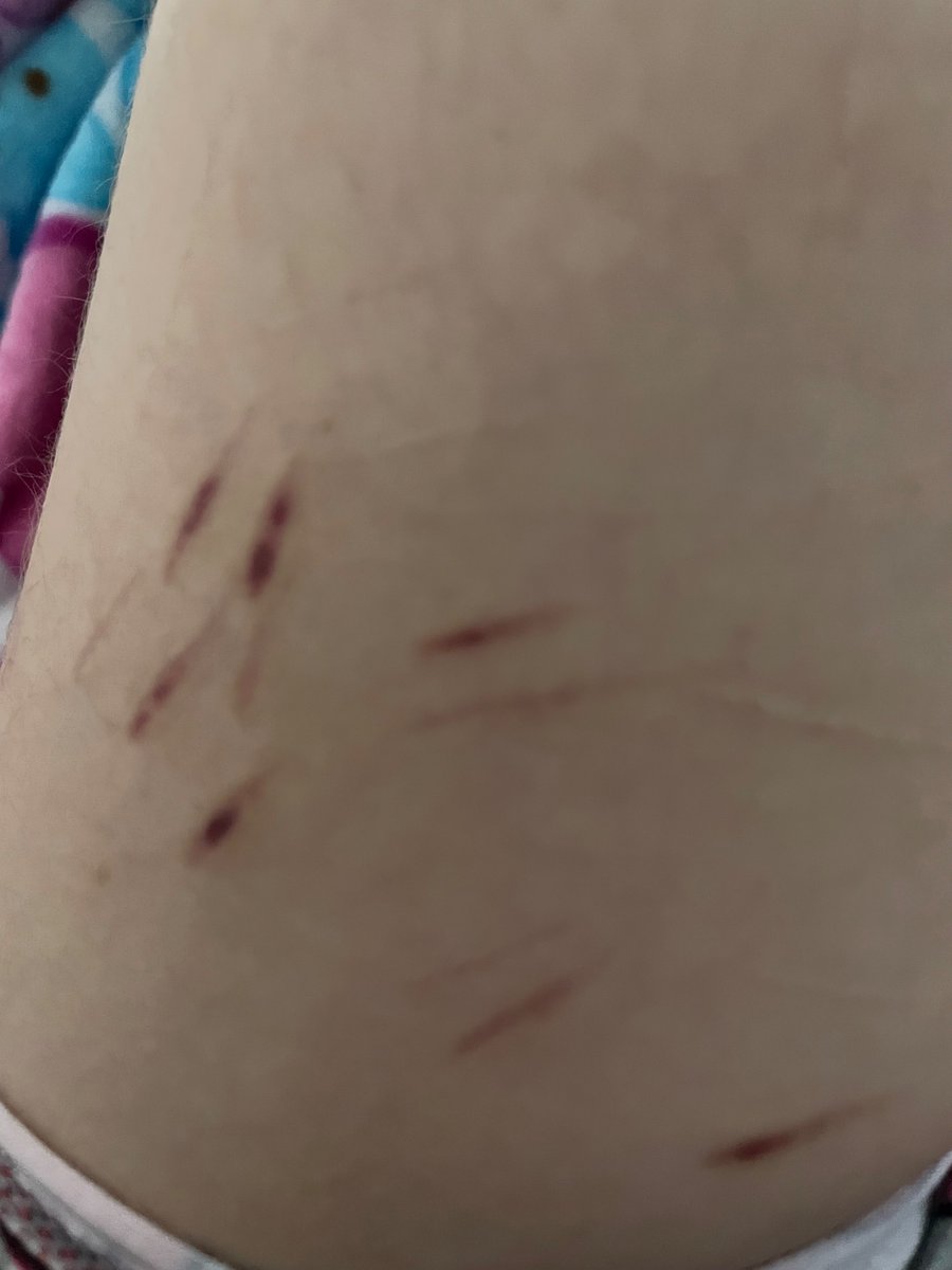 nheeeooo's tweet photo. why are these healing weird/genq
they’re like 2 months old but still red (and kinda purple sometimes) https://t.co/aWUE1xd0uk