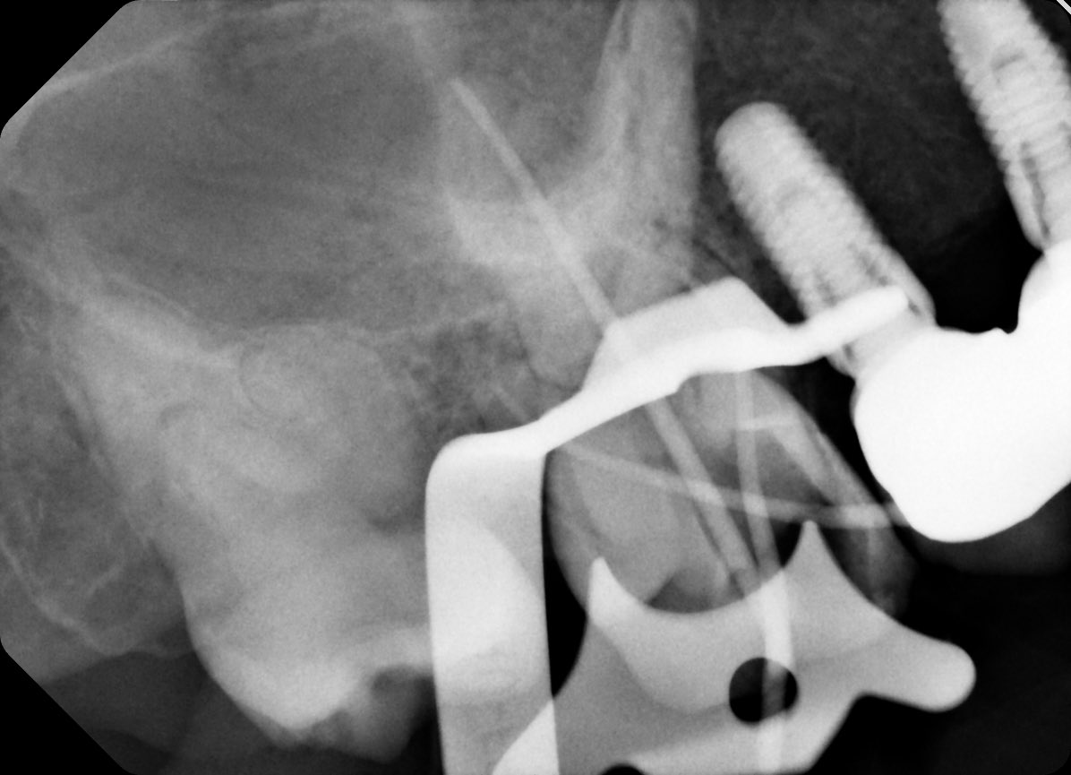FaisalOR22's tweet photo. Ending Ramadan clinics with an Endo molar ✨

Pain on biting + abscess on #16.
Dx: Necrotic pulp with chronic apical abscess.

RCT done to eliminate infection &amp; save the tooth 🦷
Perfect way to wrap up Ramadan clinics 🌙 https://t.co/ZsMUe8lv3r