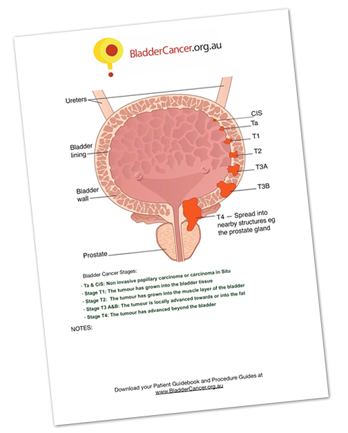 Bladder Cancer Australia tweet media