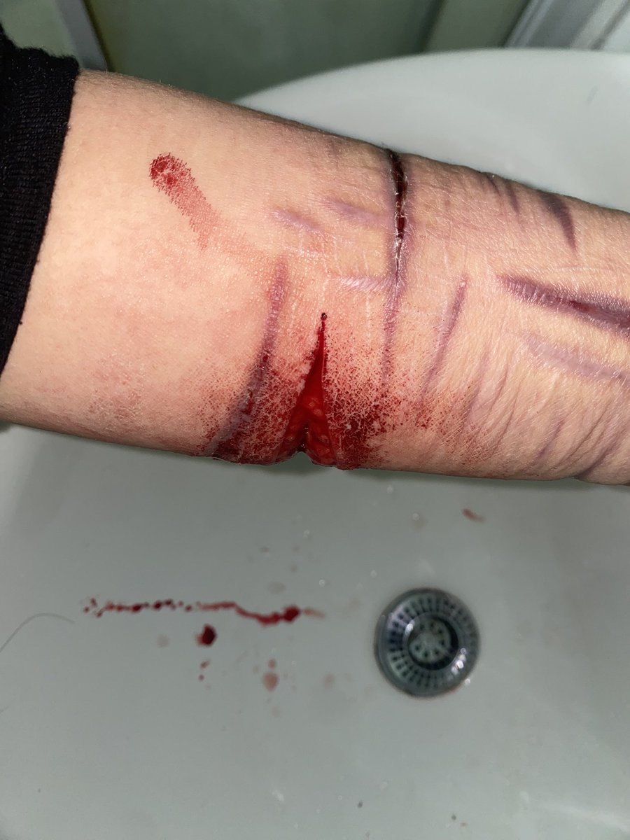 CW !! Deep beans - fascia 

I felt something tear and I stopped immediately, deepest cut ?
 (；￣Д￣)
#shedtwtᅠ #shtwt #988shtwt #slitwt #shedtwt #slittwt #beanstwt