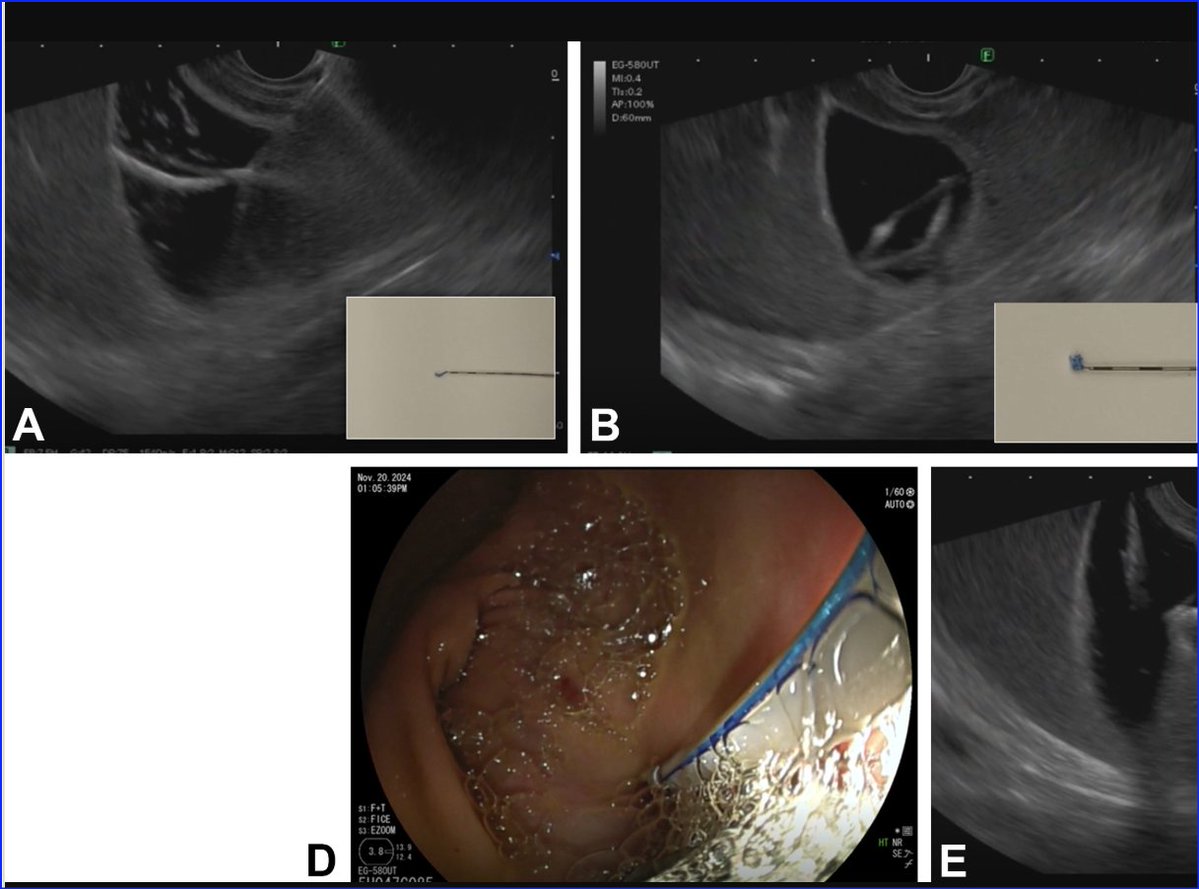 kanthMD's tweet image. Transmural gallbladder drainage using a novel endosonographic-guided suture (with video) - Gastrointestinal Endoscopy #EUS #Suture # giejournal.org/article/S0016-…
