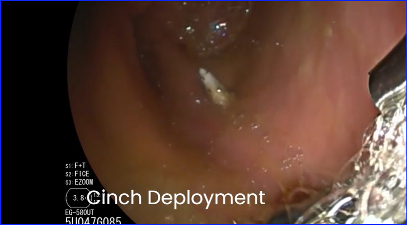 kanthMD's tweet image. Transmural gallbladder drainage using a novel endosonographic-guided suture (with video) - Gastrointestinal Endoscopy #EUS #Suture # giejournal.org/article/S0016-…