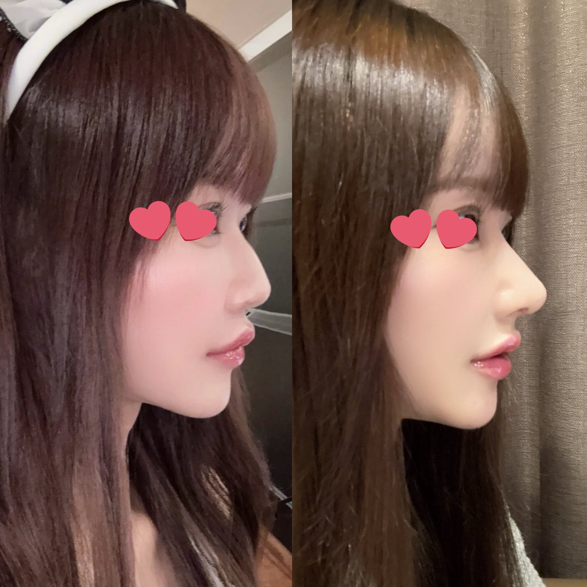 sj22___'s tweet photo. 質問来てたので
自家肋軟骨+鷲鼻矯正+骨切り幅寄せ+団子鼻矯正+鼻柱下げ
MARQイジェジュン先生@MARQ_PS https://t.co/SJFkpdmBBO