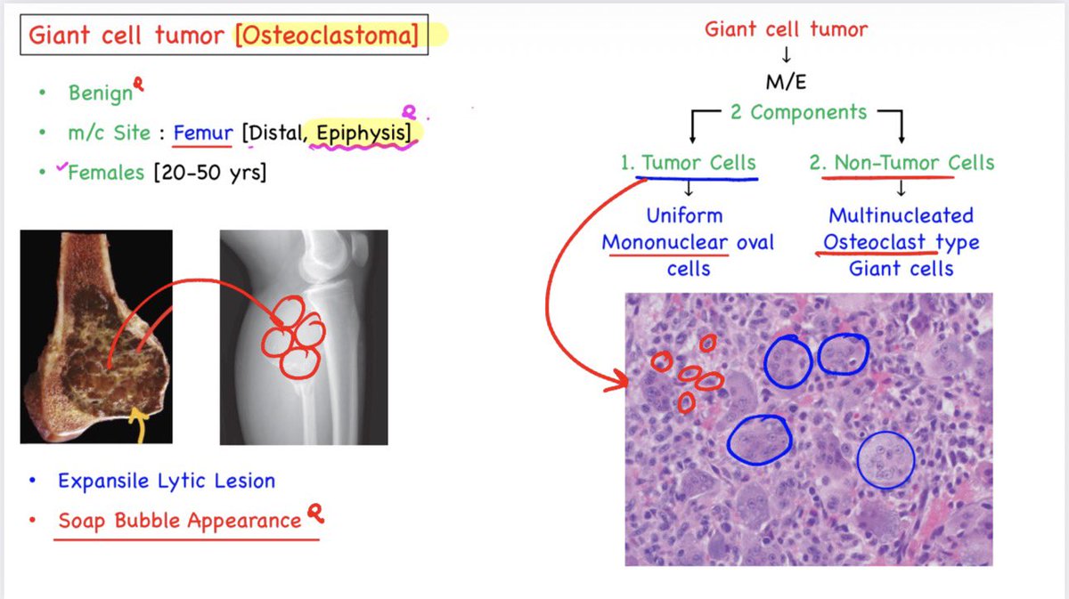 drdev555's tweet photo. 🕉 "Giant cell tumor (=Osteoclastoma)":
➖➖➖➖➖➖➖➖➖➖➖➖
👉Lecture snapshot from “Integrated Concepts of Pathology” By Dr. Devesh Mishra 👍
👉Build Concepts.
👉Strengthen Clinical Thinking.
👉Succeed with Clarity.
#drdeveshmishra #dpma #neetpg #fmge #inicet https://t.co/qs3GL3NQoE