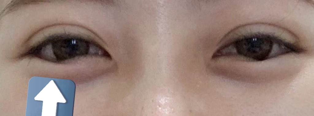 mpchan_a's tweet photo. これはガチ！
グラマラスライン形成した人特有の目の形になる(笑顔の時)
目尻側？あたりから垂れさせる手術だから、笑顔の時の目の形が不自然なんよ常にそこだけ固定されてる感じ https://t.co/jXfJnKF9jL