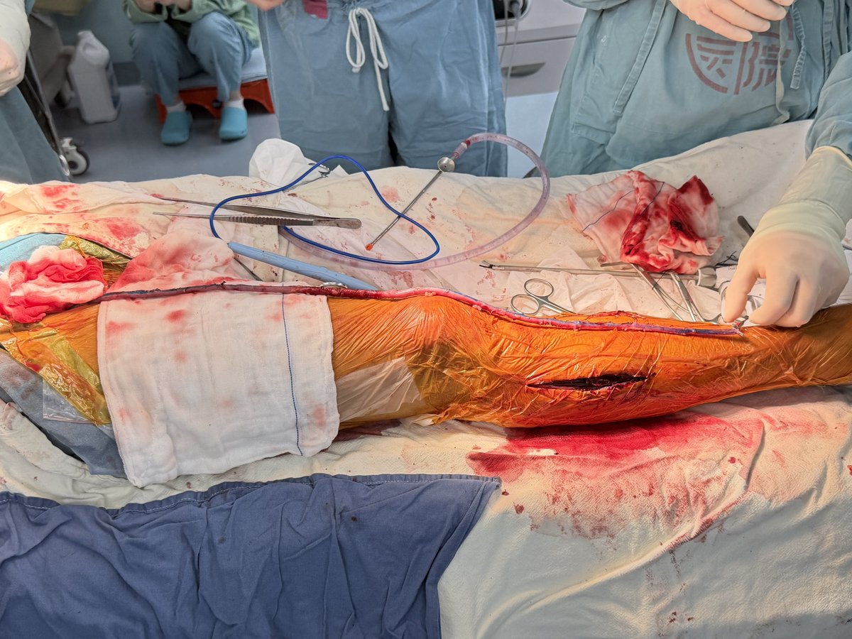 Jianing Yue_Vas Surg in Shanghai tweet media