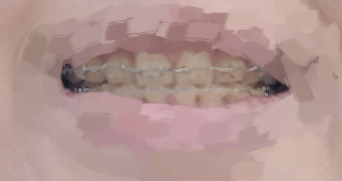 doguday's tweet photo. 歯列矯正の調整へ行ってきたのですが、正中がこの状態で「リテーナーに進む」と言われたのですが普通なのですかね…？
正中ちゃんと合わせて欲しいのですが私が気にしすぎなのかな… https://t.co/V0YCtl9696