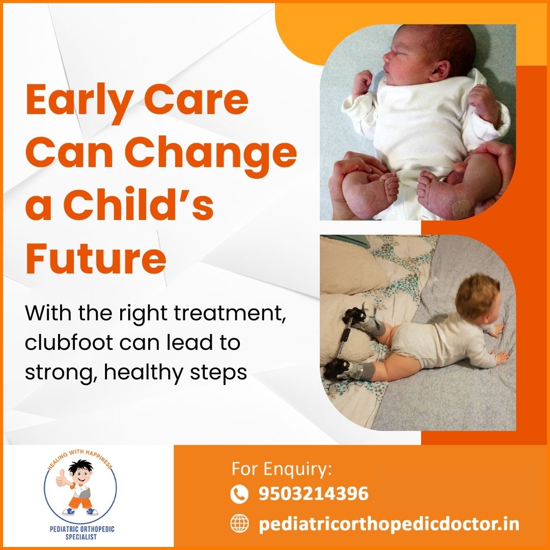 OrangePune's tweet image. Clubfoot is a common condition, and early intervention makes all the difference.
With expert treatment and consistent care, most children achieve normal, healthy mobility.
#ClubfootAwareness #HappyFeet #HealthySteps #ChildOrthopaedics #PaediatricCare #EarlyIntervention