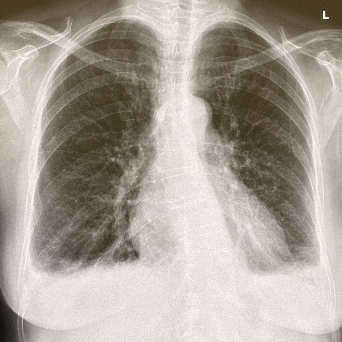 elearnrad's tweet photo. What are the chest findings? https://t.co/5ZzhpSELJh