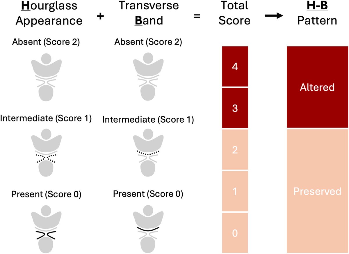 Perineal structural changes on 3-dimensional endovaginal ultrasound 6 months after difficult vaginal birth: the Hourglass-Band pattern and how it relates to levator ani avulsion and hiatus size - Schematic of the H-B pattern scoring system ajog.org/article/S0002-…