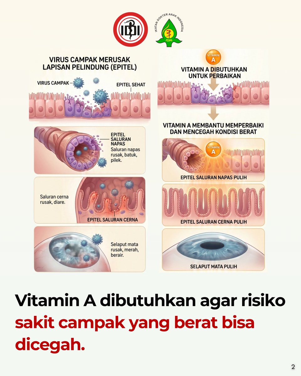 idai_tweets's tweet image. Catat Bapak Ibu!
Ini rekomendasi IDAI terkait pemberian Vitamin A pada anak yang sakit campak.

Pak,Bu, tetap waspada ya.

#WabahCampak
#ImunisasiLengkap
#IDAI
#IndonesianPediatricSociety