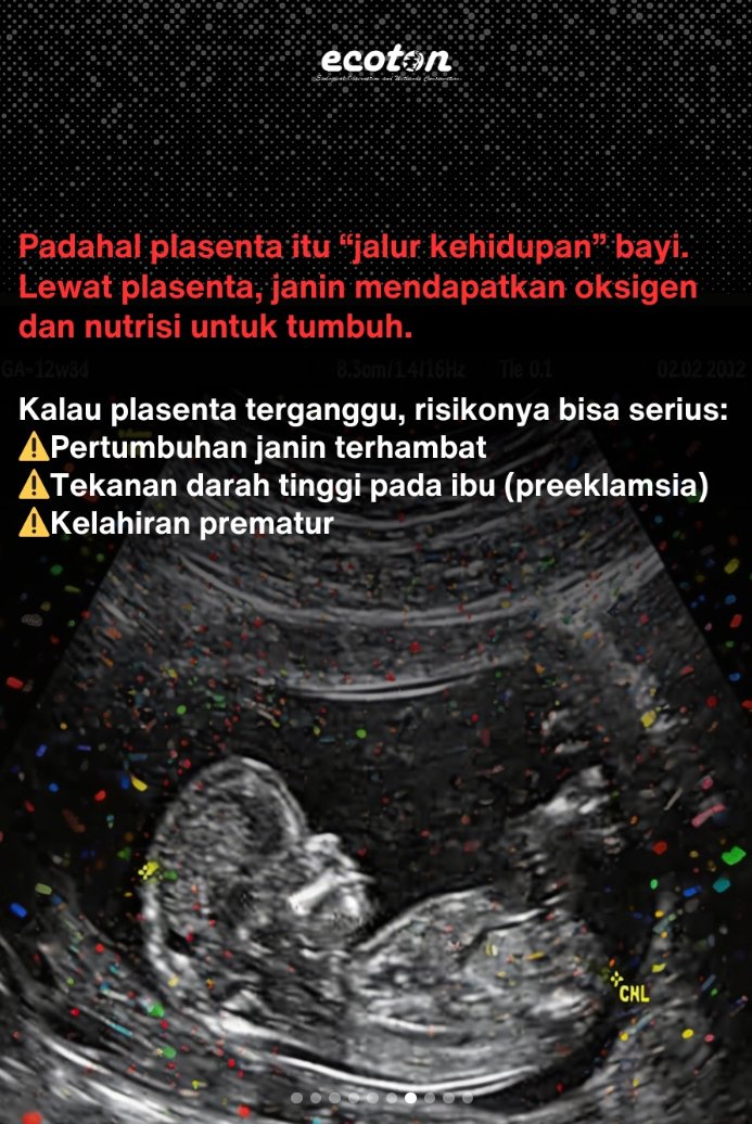 Kontaminasi Mikroplastik pada Janin!

Sebuah penelitian Ecoton bersama FK UNAIR dan Lab FTIR UIN Sunan Ampel Surabaya menemukan Air ketuban dari 42 Ibu hamil 100% mengandung mikroplastik!!!

40.5% nya  berasal dari plastik PE yaitu plastik yang digunakan sehari-hari seperti botol
