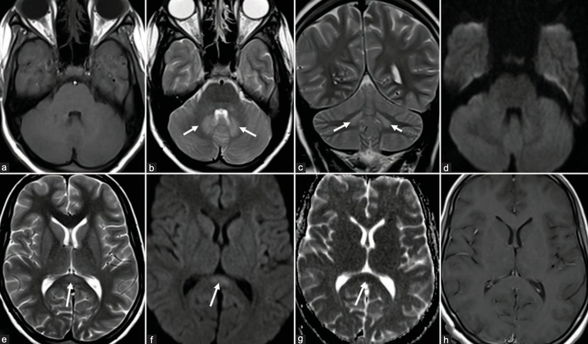 Annals of Indian Academy of Neurology tweet media