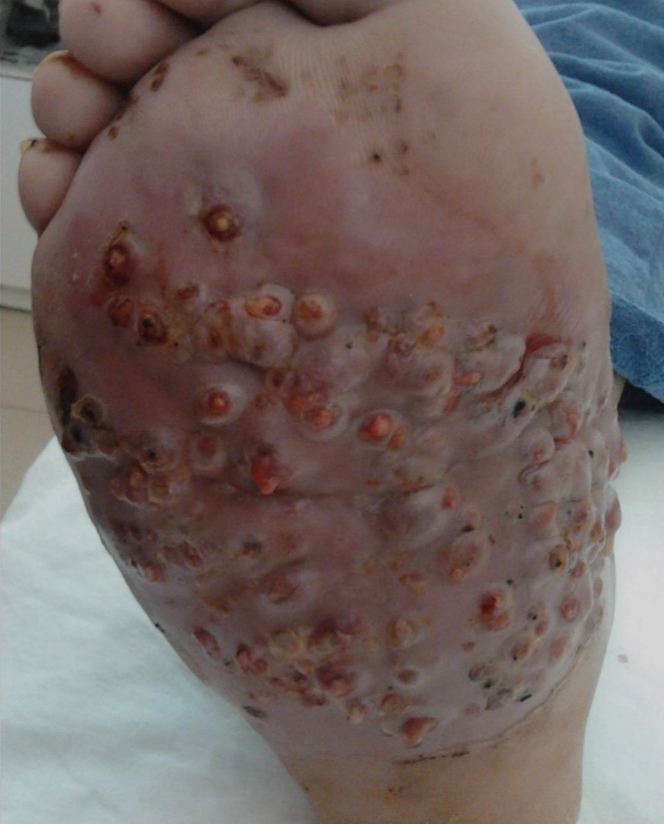 SameerYogi14's tweet photo. A farmer presents with chronic progressive swelling of the foot. Examination shows multiple nodules and sinus openings on the sole with discharge of granular material.
What is the diagnosis?
#MedX #MedTwitter #neetpg 
@DrAkhilX @Dr_Shiv_kumar_ @IhabFathiSulima @DocPriyamMD @DrNovinoTailor