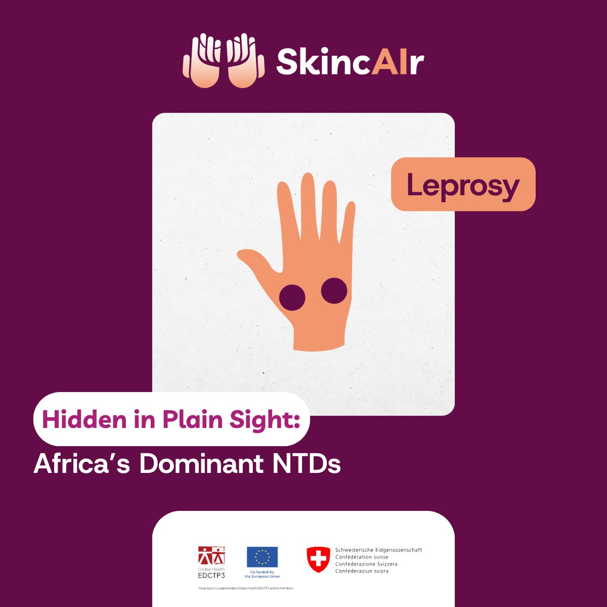 SkincAIr's tweet photo. 3️⃣ Leprosy is curable, but late diagnosis causes permanent disability.

💡 SkincAIr aims to support health workers with AI-assisted early detection tools.
Ending stigma starts with early diagnosis.

#NTDsWorldDay #SkinNTDs #SkincAIr @EDCTP3 https://t.co/rhRm7g6c4t