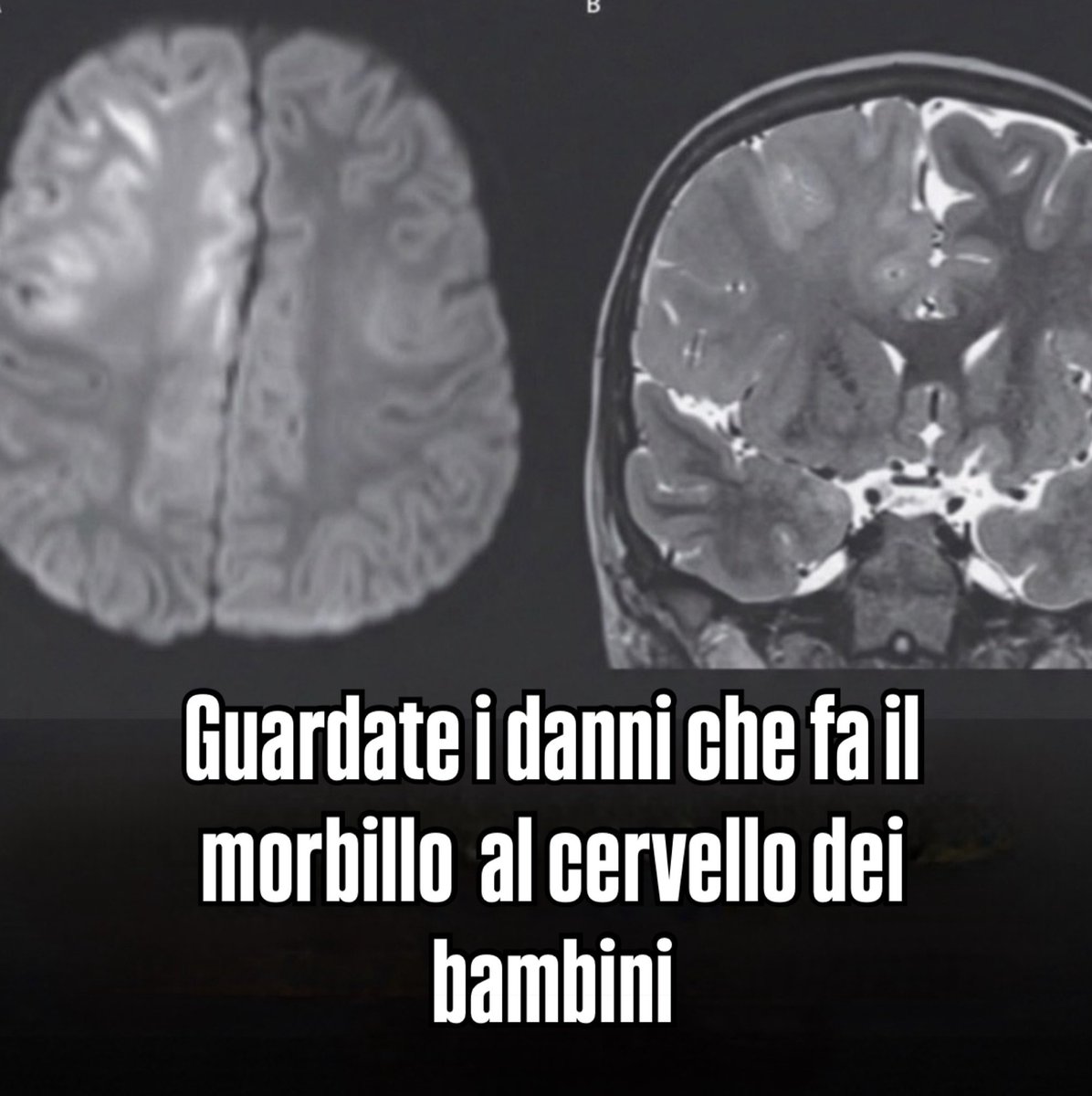 ‼️Ecco cosa ha fatto il #morbillo al #cervello di un bambino che lo ha avuto a 7 mesi. 

🗓️In un recente articolo pubblicato sul New England Journal of Medicine si descrive la tragica morte di un bambino di 7 anni a causa di panencefalite subacuta sclerosante (PESS), una rara