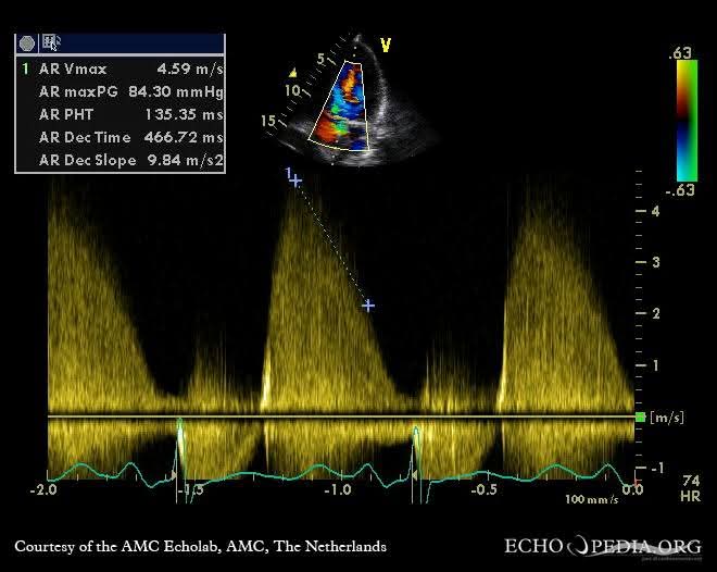 Ahmedata7777's tweet photo. Aortic Regurgitation Grading by Pressure Half-Time https://t.co/867Oaed5Y0