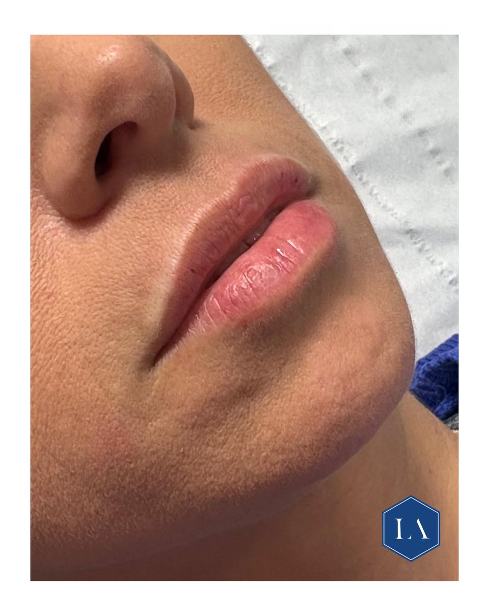 Just 0.5ml 💉
Restored hydration.
Restored volume.
Photos taken immediately post-procedure with minimal
trauma.
Precision over excess. Always.
This is artistry.

#AestheticTreatments #lips #nofilterneeded
#19yearsofexcellence #injectableart #luxtonaesthetics