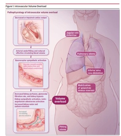 SOMELaguna's tweet photo. Evaluación Clinica de la Sobrecarga de Volumen 💧🏥

🔰📚JAMA 2026

doi:10.1001/jama.2026.0446

Enlace a Artículo Completo👇🏻✅🆓
https://t.co/rPEDXf5xvO https://t.co/6sbDOkZje0