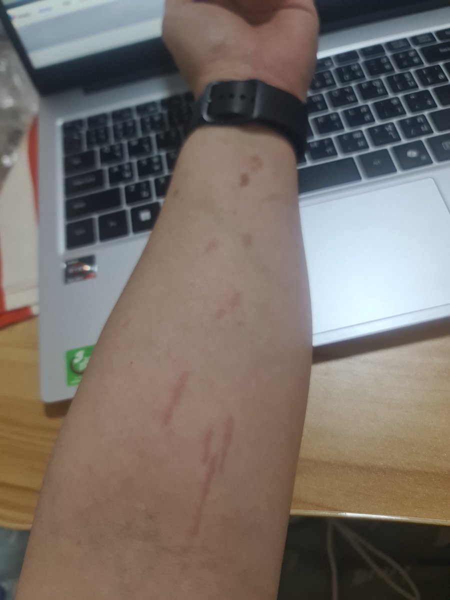 เพิ่งเข้าใจคำว่า"วันนี้ไม่ใช่วันของเรา"
-ก้อนเนื้ออักเสบเพราะภูมิตกที่ท้ายทอยเจ็บมากจนต้องไปหาหมอ
-ทำผัดซีอิ๋ว น้ำมันกระเด็นใส่แขน
-ลืมกระเป๋าคอมท้ายรถ และ หล่นหาย
-ขับรถไปที่ทำงานมีมอเตอร์ไซต์ปาดหน้า ใจดีเบรคให้ เซฟชีวิตคนอื่น ผลคือของที่วางด้านหลังหล่นพังพินาศ😮‍💨MyGoodDayมั้ง