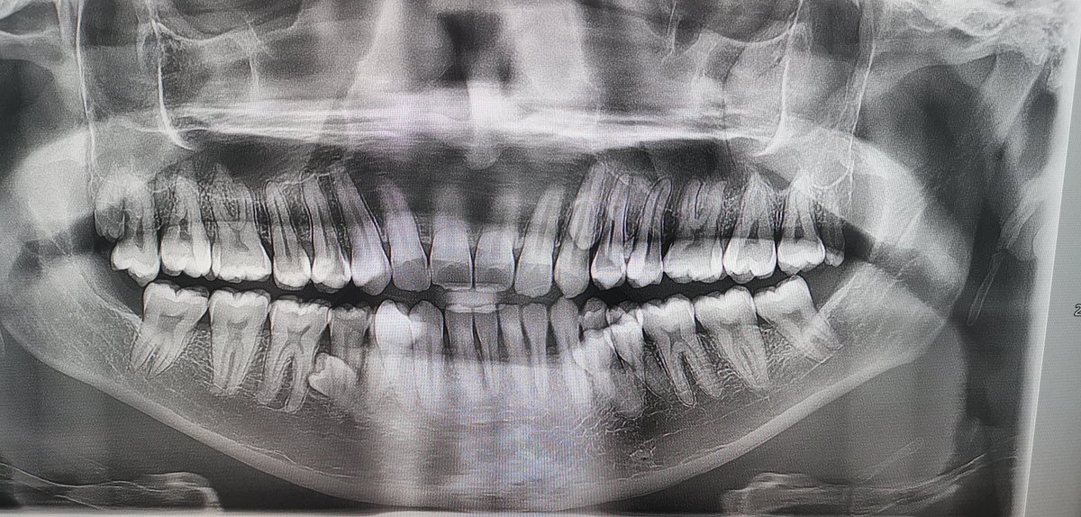 SMILE 😁

Prathab Muniandy from Malaysia has 42 teeth, 10 more than usual, meaning he holds the record for most teeth in a person’s mouth (male) 🦷