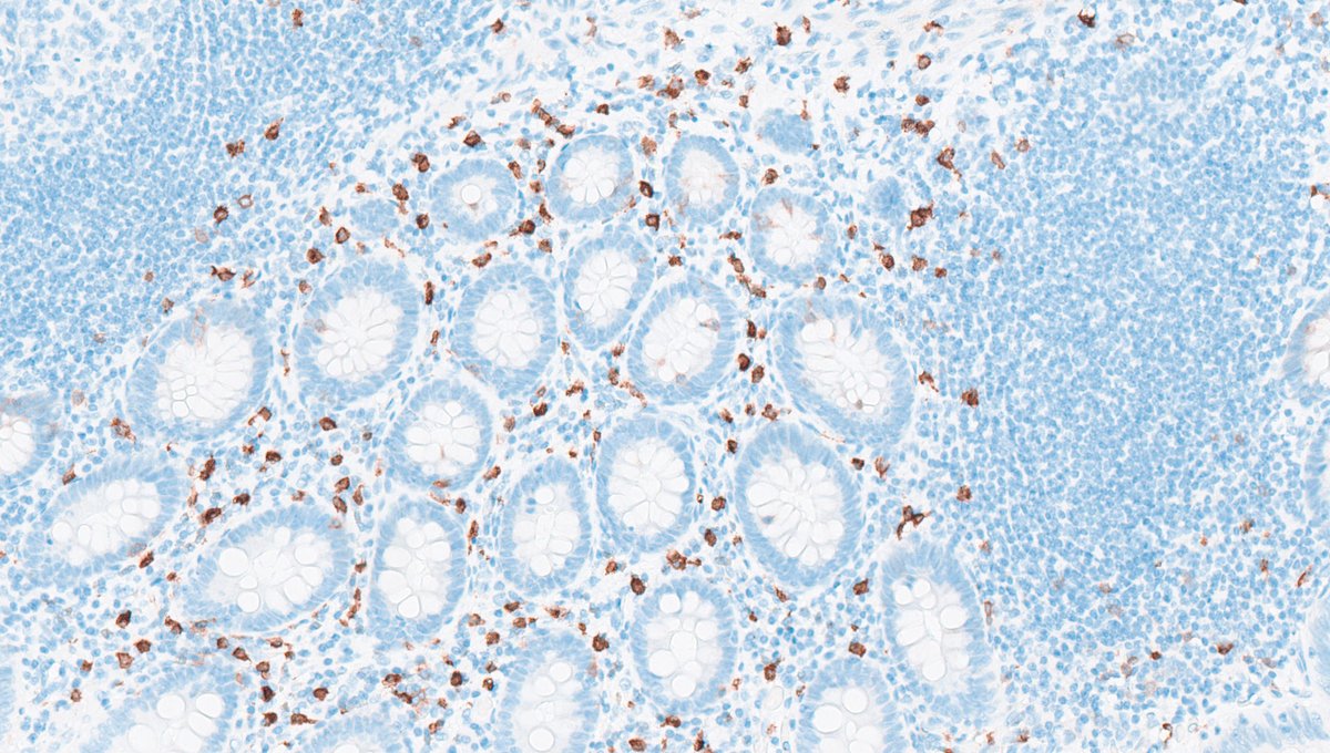 ukneqasicc's tweet photo. Antibody spotlight: CD117
CD117 is positive in ~95% of gastrointestinal stromal tumours (GIST) and plays an important role in diagnosis and treatment selection.
Internal controls are essential for reliable IHC interpretation.
#UKNEQASICCISH #GIST #EQA https://t.co/LSFN4RTjFX