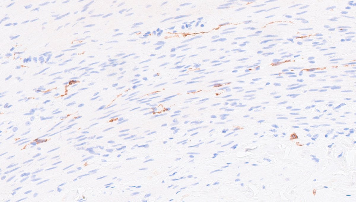 ukneqasicc's tweet photo. Antibody spotlight: CD117
CD117 is positive in ~95% of gastrointestinal stromal tumours (GIST) and plays an important role in diagnosis and treatment selection.
Internal controls are essential for reliable IHC interpretation.
#UKNEQASICCISH #GIST #EQA https://t.co/LSFN4RTjFX