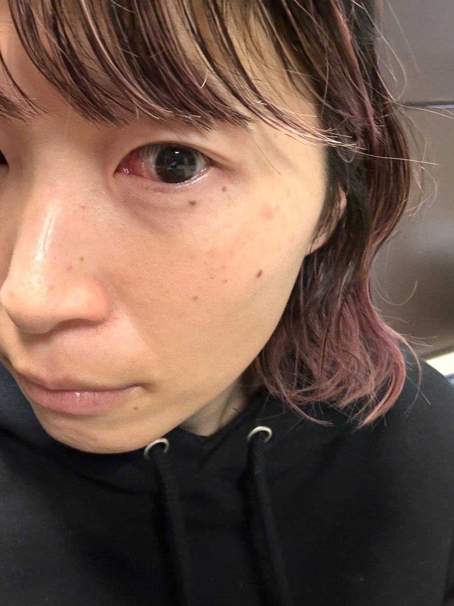 充血して（花粉）、殺人鬼みたいな目やったわ