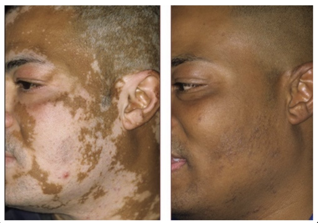 DrJackKruse's tweet image. 20 years ago I sent a diabetic with acanthosis nigracans and vitiligo to a lab with a photomultiplier.  

Placing photomultiplier (PMT) tube over a patch of Acanthosis Nigricans was be the ultimate experimental "Gotcha" for my decentralized thesis.

In a clinical setting, doctors