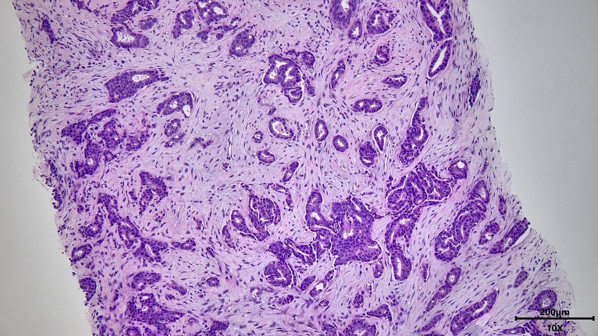 VickeryJasmine's tweet image. Breast core needle biopsy showing invasive ductal carcinoma. Not everything with &amp;gt;75% tubules is well differentiated! Don't fall for it! There is necrosis, mitoses, and nuclear pleomorphism with prominent nucleoli #breastpath #pathX #pathtwitter