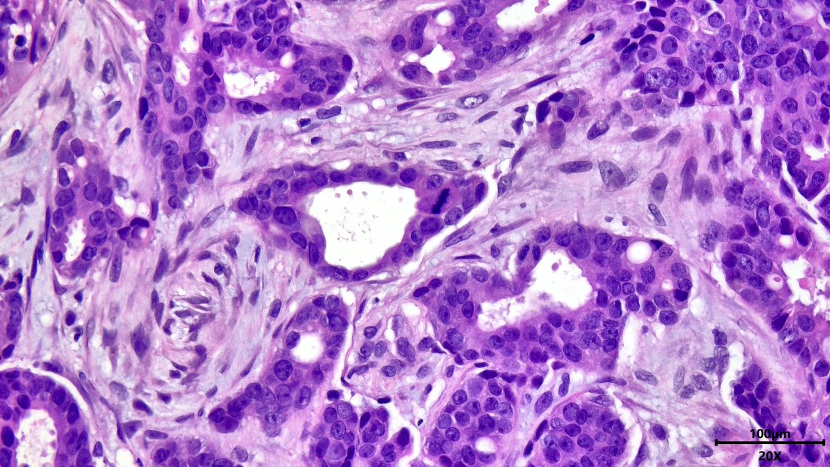 VickeryJasmine's tweet image. Breast core needle biopsy showing invasive ductal carcinoma. Not everything with &amp;gt;75% tubules is well differentiated! Don't fall for it! There is necrosis, mitoses, and nuclear pleomorphism with prominent nucleoli #breastpath #pathX #pathtwitter